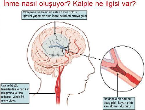 İnme bir kalp hastalığıdır