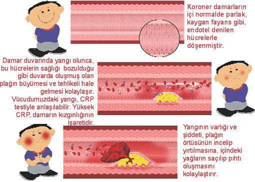 Statinler kolesterolü düşürürken yangıyı da önlüyor