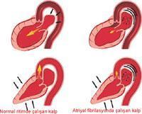 Sık rastlanan bir çarpıntı: Atriyal Fibrilasyon