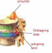 Belde ağrı nasıl oluşuyor