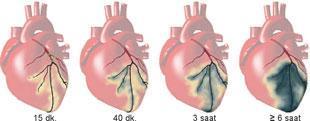 Kalp krizinde acil müdahale