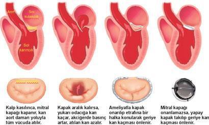 Kalp kapağını onarmak için ameliyat şart mı