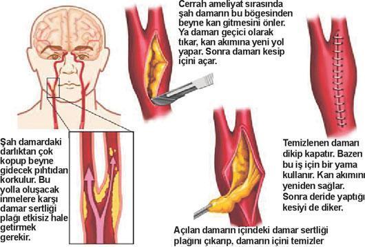 Şah damarı daralırsa ne yapılabilir