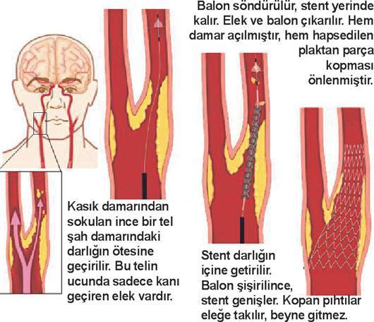 Şah damarı daralırsa ne yapılabilir