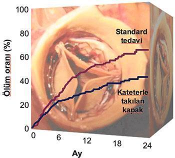 Yeni kalp kapağı hayat kurtarıyor