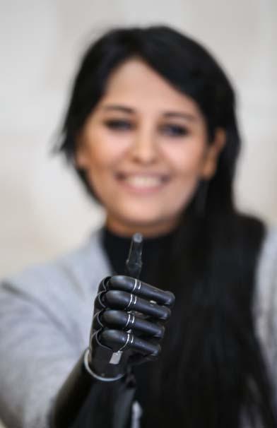 Biyonik kolu yüzünü güldürdü Biyonik kolu yüzünü güldürdü