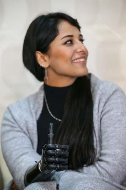 Biyonik kolu yüzünü güldürdü Biyonik kolu yüzünü güldürdü