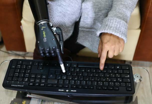 Biyonik kolu yüzünü güldürdü Biyonik kolu yüzünü güldürdü