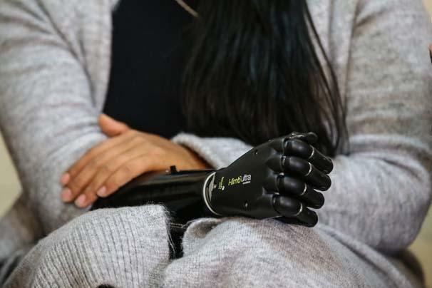 Biyonik kolu yüzünü güldürdü Biyonik kolu yüzünü güldürdü