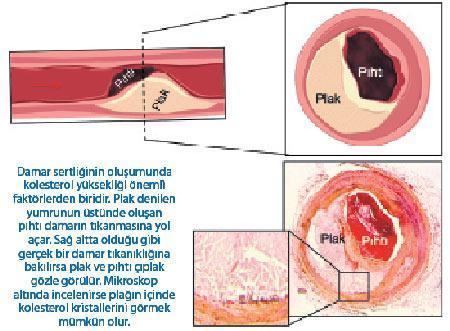 Kolesterole yeni ilaçlar