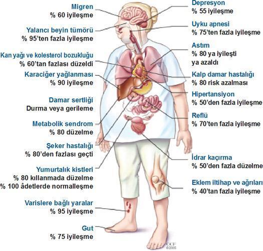 Zayıflamak için son çare ameliyat