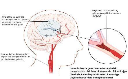 İnmeyi önlemenin altın kuralları