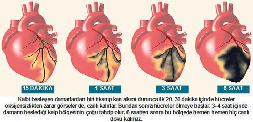 Kalp krizinde hayat kurtaran yöntemler