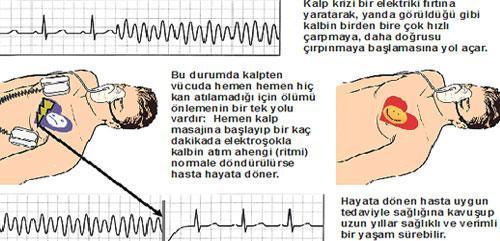 Kalp krizinde hayat kurtaran yöntemler