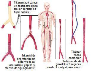 Tıkanan damarları açmak yeterli değil