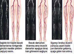 Tıkanan damarları açmak yeterli değil