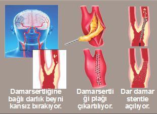 Tıkanan damarları açmak yeterli değil