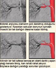 Tıkanan damarları açmak yeterli değil