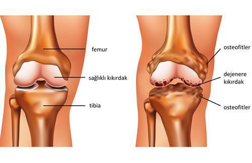 Dizinizdeki ağrıya dikkat