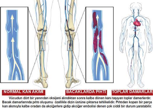 Uçak yolculuğu hasta edebilir