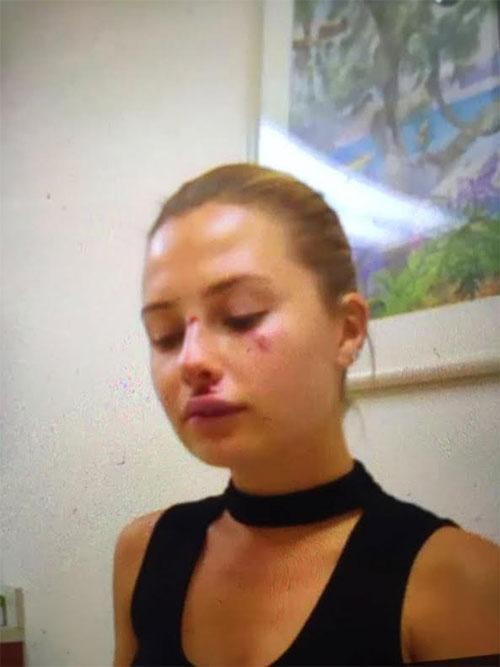 Chloe Loughnan kaza sonrası bu hale geldi