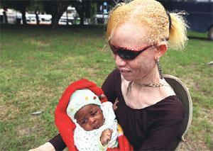 Türkiye Tanzanya’da albino köyü kuruyor