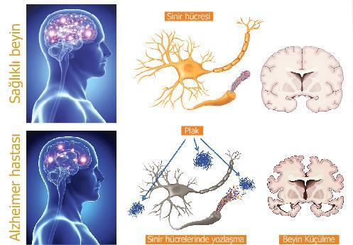 Alzheimer’dan  nasıl korunuruz