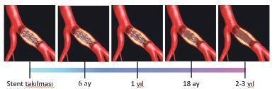 Kalp hastalığında ilaçlı stentler