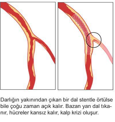 3 aşamada kalp krizi tedavisi