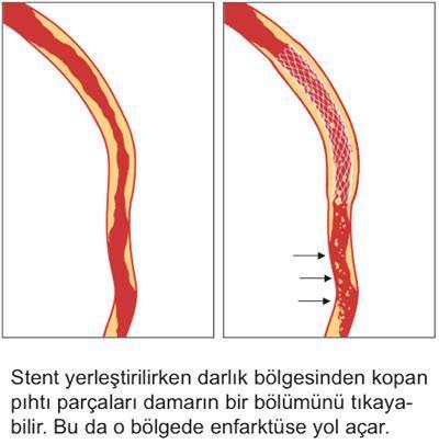 3 aşamada kalp krizi tedavisi