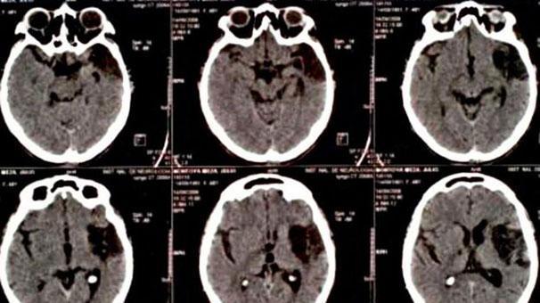 Dünyada yüz kişide görülen hastalık: Yaşayan ölü sendromu