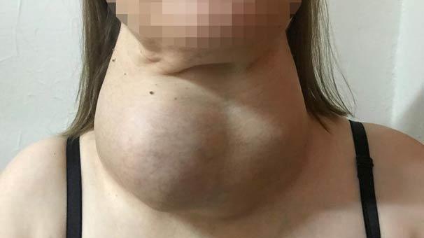 Ameliyattan korktu yillarca böyle yaşadi