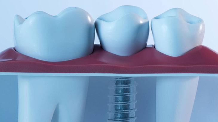 İmplant ne zaman yerleştirilir