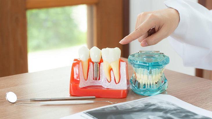 İmplant kemik kaybını engelliyor