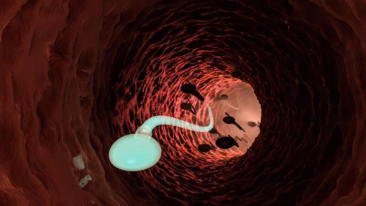 3-Mikro-TESE ile canlı sperm hücresi bulunabilir