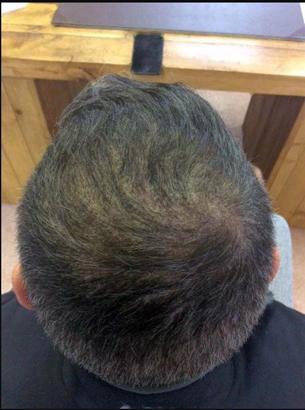 -2 haftalık tedavi sonrası saçlarının son hali-