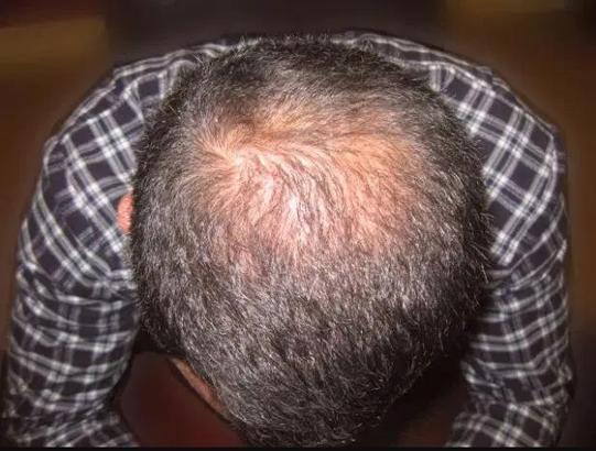 Efsane isim saç ektirmeye karar verdi Saklanıyordum...