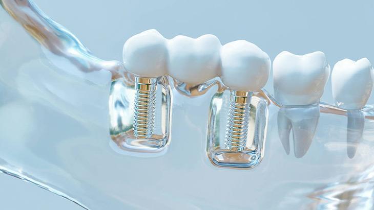 4-İmplant yapıldıktan sonra çenede uyuşukluk neden olur