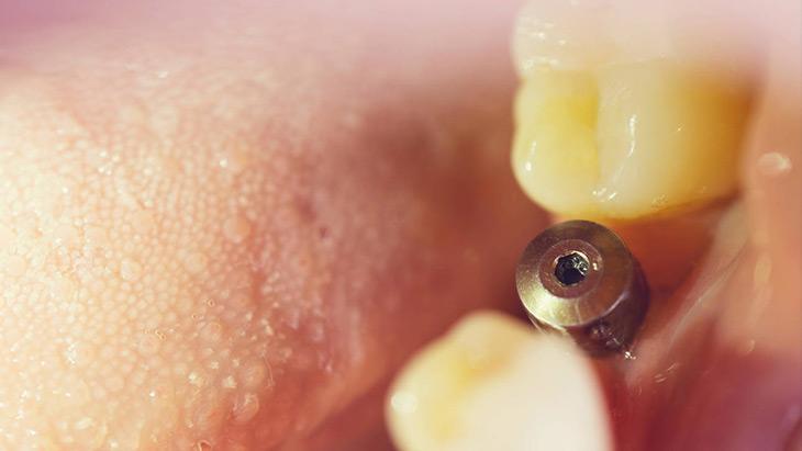 6-İmplant neden oynar