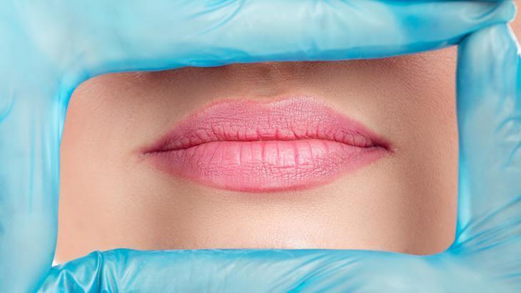 Dudak üstü sigara çizgilerini geçirmenin yolu - Yüzdeki barkod çizgileri nasıl tedavi edilir Dudak üstü sigara çizgilerini geçirmenin yolu - Yüzdeki barkod çizgileri nasıl tedavi edilir