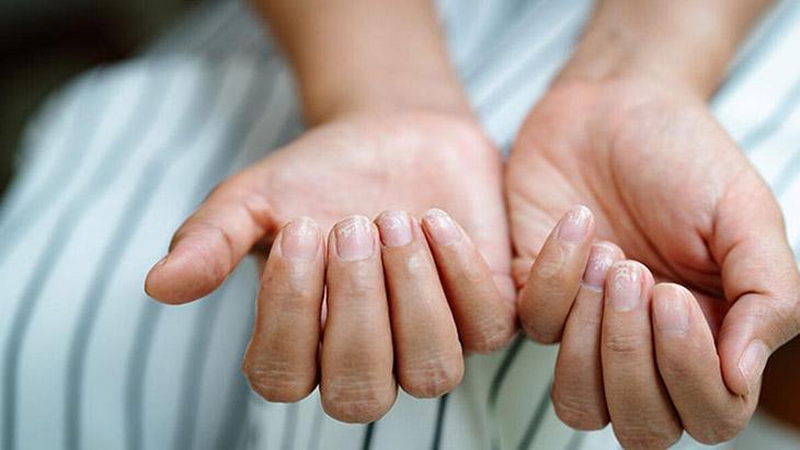 Uzmanı uyardı Tırnak yiyenler enfekte olabilir
