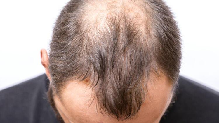 Saç dökülmesine yol açan sebepler nelerdir Saç dökülmesine yol açan sebepler nelerdir