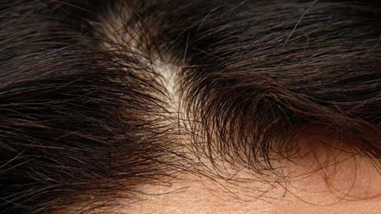 Koronavirüs sonrası saç dökülmesini durdurmanın yolları - Koronavirüs saç döker mi Koronavirüs sonrası saç dökülmesini durdurmanın yolları - Koronavirüs saç döker mi