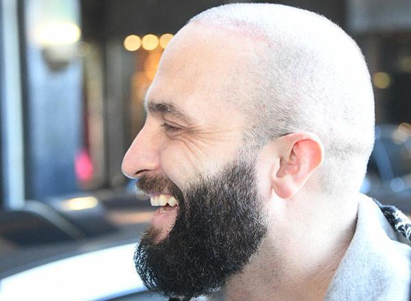 Berkay saç ektirdi: Nasıl olmuş