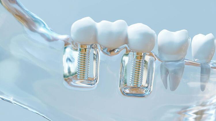 Doğru yapılmazsa kemik kaybı yaşanabilir