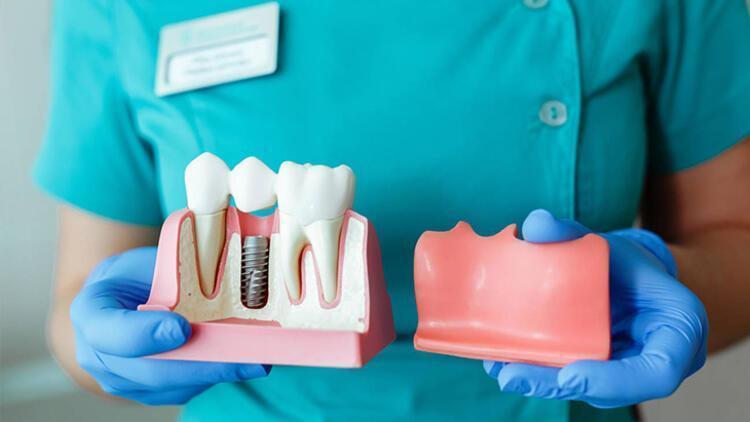 Diş implantlarının özellikleri nelerdir