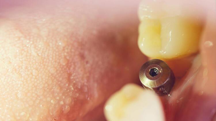 Diş implantları gerçek dişlere benziyor mu