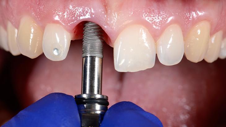 Diş implantları ile gerçek diş arasında bir fark var mı