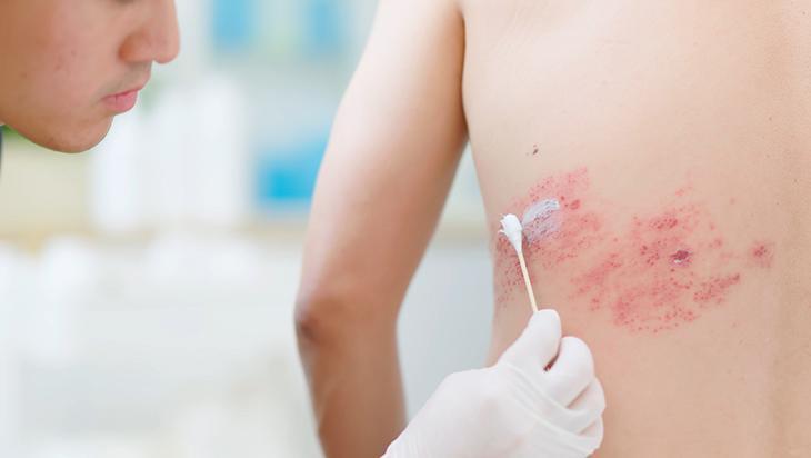10 günde azalmıyorsa doktora başvurun