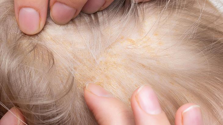 Yumuşatıcılar rafa kalksın, sabun tozları ortaya çıksın Bu 3 yöntem egzamayı bitiriyor